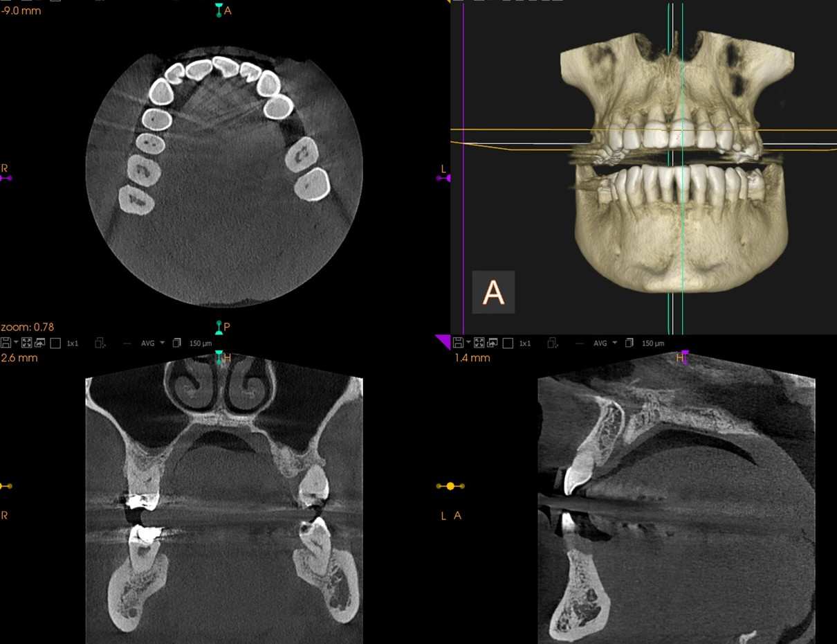 Cbct Scan