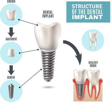 Dental Implant Structure